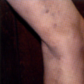 Varicose and Spider Veins treatment Venice Englewood Sarasota North Port Charlotte Punta Gorda Florida Board Certified Surgeons Dr Issam Halaby Dr Bryan Smith