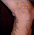 Varicose and Spider Veins treatment Venice Englewood Sarasota North Port Charlotte Punta Gorda Florida Board Certified Surgeons Dr Issam Halaby Dr Bryan Smith